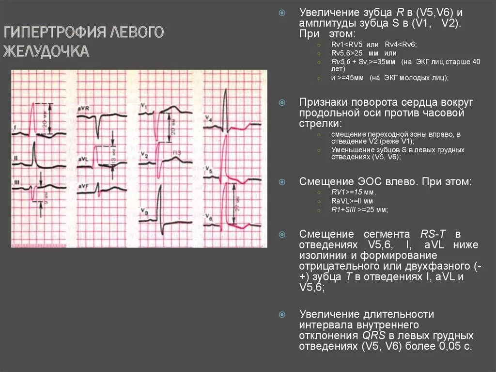 Заболевания левого желудочка. Гипертрофия левого желудочка на ЭКГ. Гипертрофия левого желудочка ЭКГ зубец r. ЭКГ признаки гипертрофии миокарда лж. Синдром гипертрофии левого желудочка симптомы.