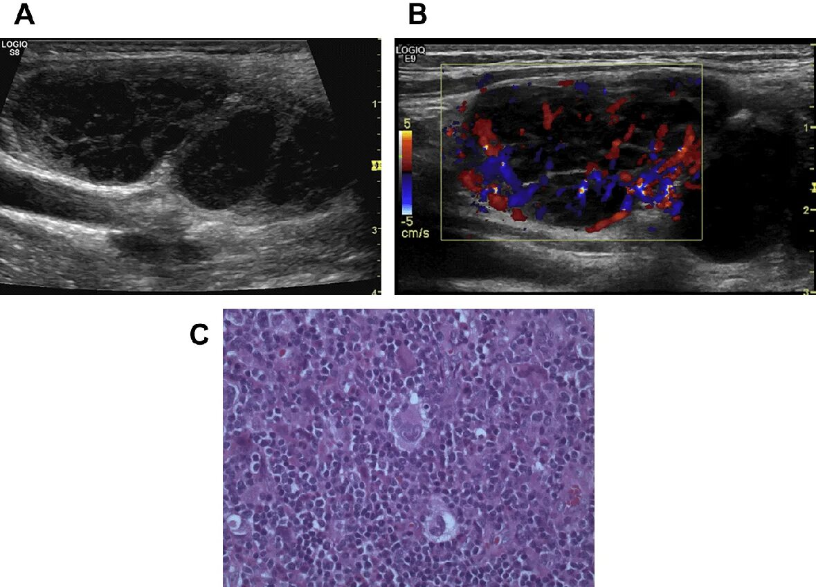 Лимфогранулематоз УЗИ лимфоузлов. Лимфома Ходжкина лимфоузлы на УЗИ. Лимфогранулематоз селезенки УЗИ. Цдк лимфоузлов
