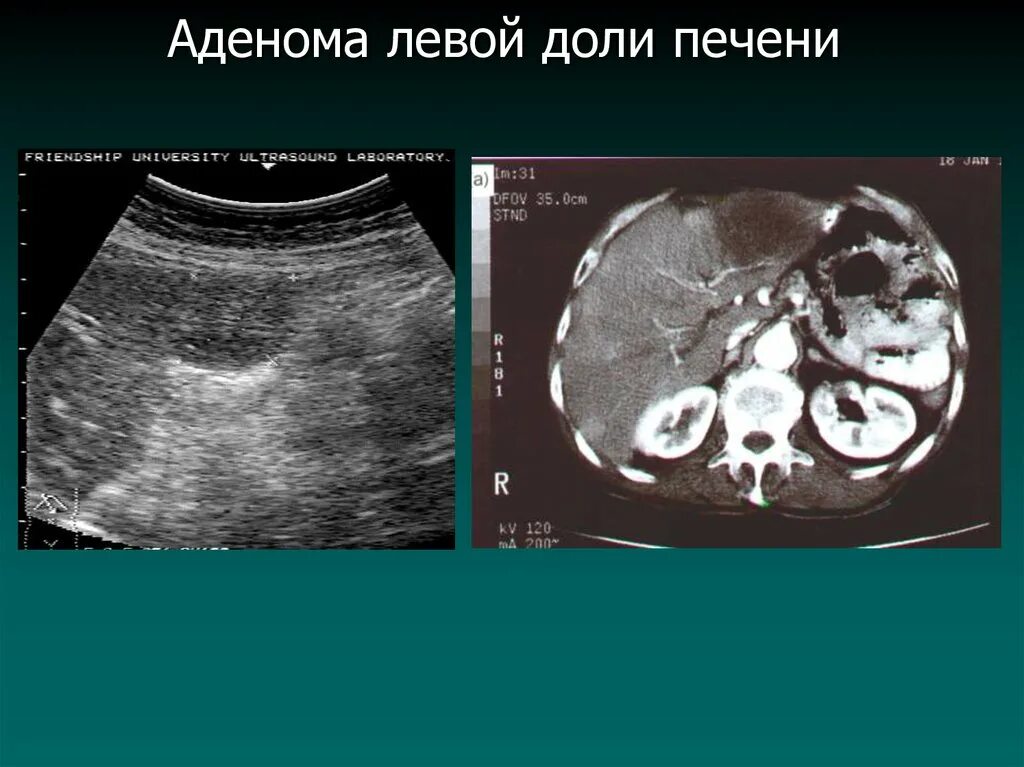 Образование в правой доле печени. Гепатоцеллюлярная аденома печени УЗИ. Эхограммы аденомы печени. Гепатоцеллюлярная аденома мрт.