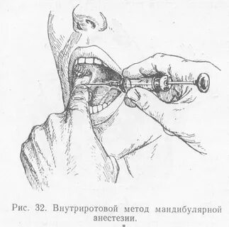 Техники анестезии в стоматологии