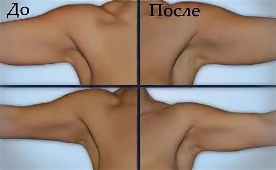 Липосакция плеч до и после отзывы Липосакция ростов на дону отзывы