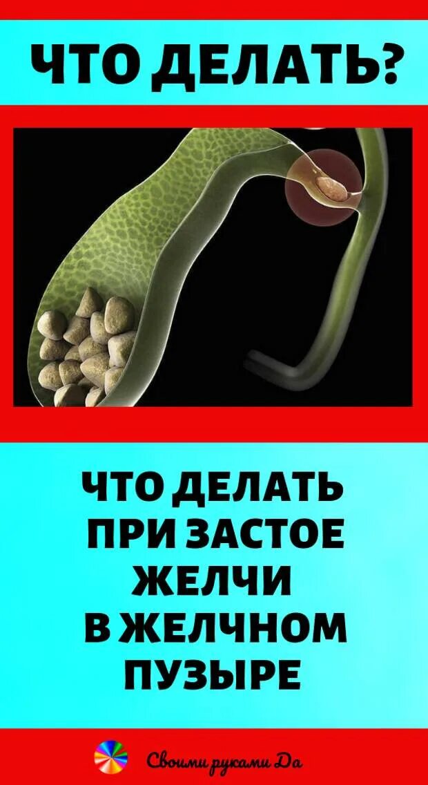 Сгущение желчи в желчном. Застой желчи в желчном. застойная желчь в желчном.