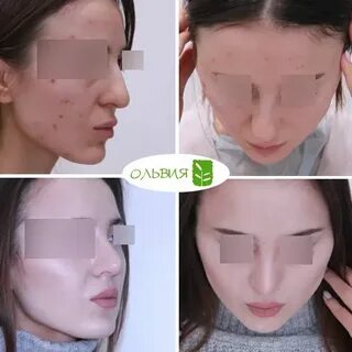 Текст песни ринопластика kai