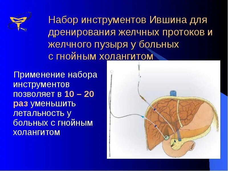 Катетер желчного пузыря. Дренирование желчного пузыря. Дренирование желчных протоков. Наружное дренирование желчного пузыря.