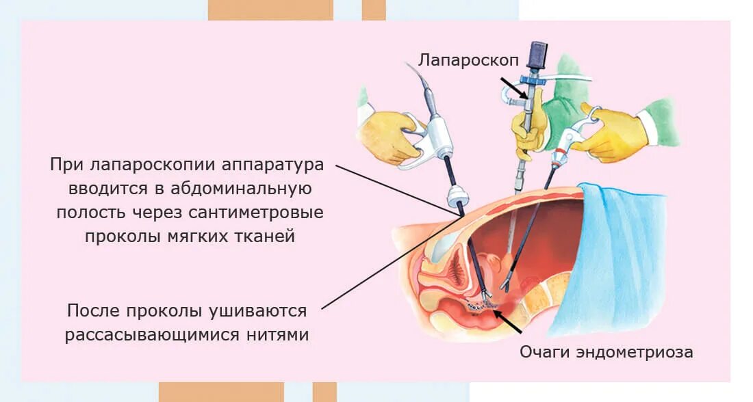 Тенорафия этапы операции. Лапароскопия параовариальной кисты. Операции при наружном эндометриозе. Микродискэктомия этапы операции.