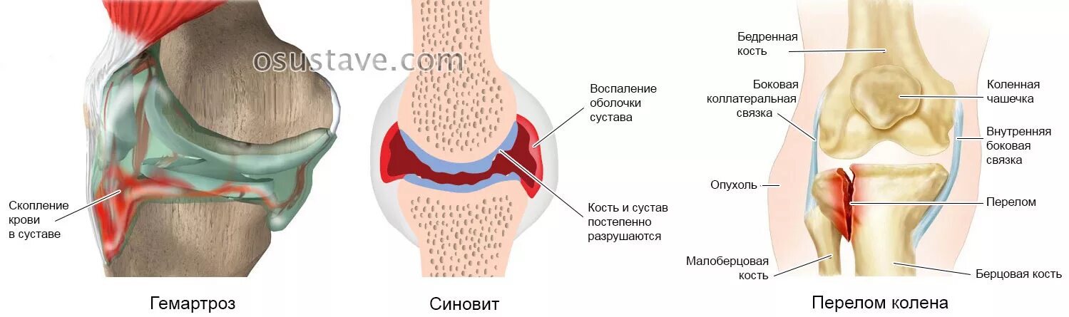 Гемартроз тазобедренного сустава. Что такое синовит коленного коленного сустава. Гемартроз коленного сустава травма.