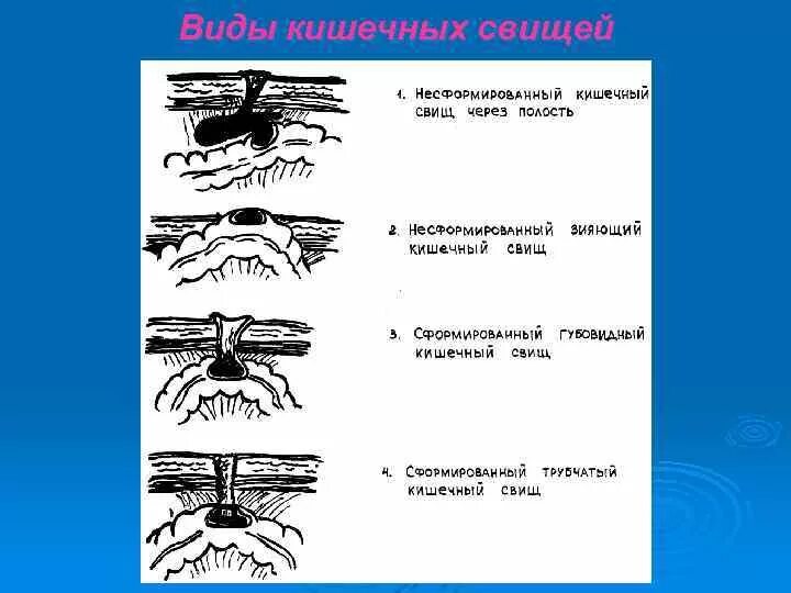 Кишечный свищ. Кишечный свищ