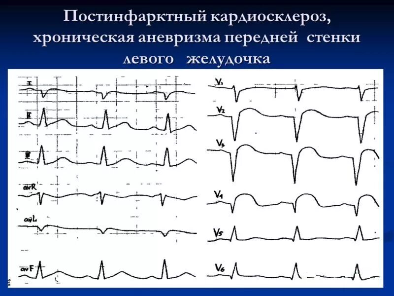 Изменение миокарда передне перегородочной области. Изменения на ЭКГ постинфарктный кардиосклероз. ЭКГ при постинфарктном кардиосклерозе. Изменения на ЭКГ при постинфарктном кардиосклерозе. ЭКГ при ИБС: постинфарктный кардиосклероз.