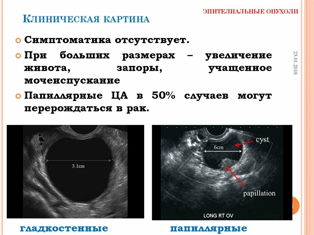 Доброкачественные опухоли яичника рекомендации. Клинические симптомы опухоли яичников. Эпителиальные опухоль яичника УЗИ. Объемные образования яичников на УЗИ. Объемное образование яичника УЗИ.