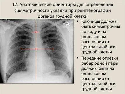 Рентген грудины укладка