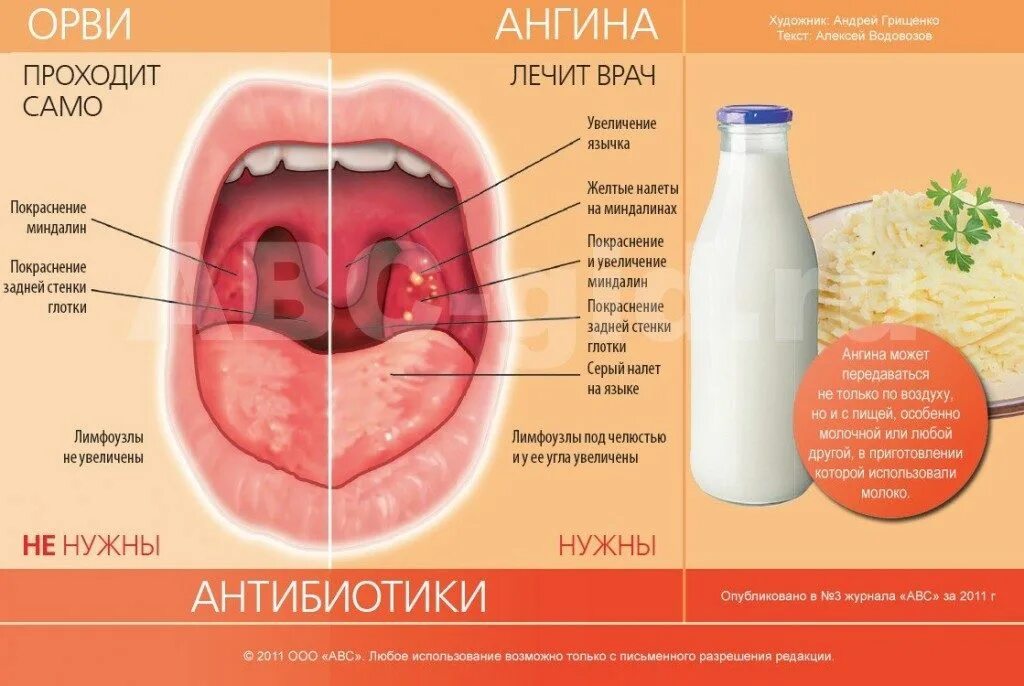 Первая помощь при ангине
