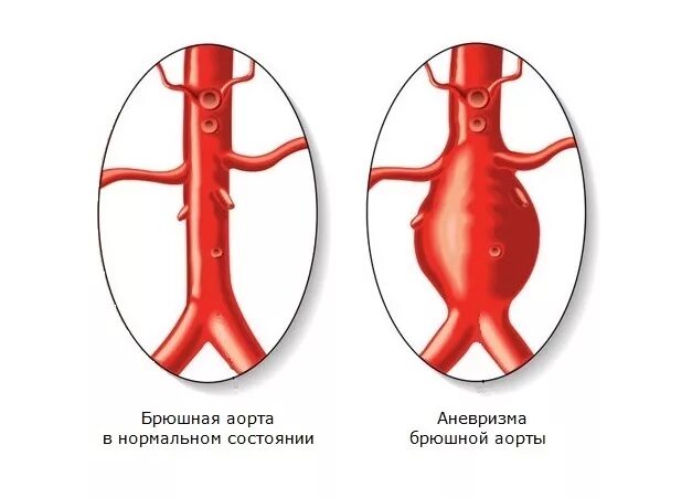 Атеросклероз брюшного. Аневризма брюшной отдел аорты отделы. Патология брюшного отдела аорты. Аневризма брюшного отдела аорты. Аневризмы абдоминальной аорты.