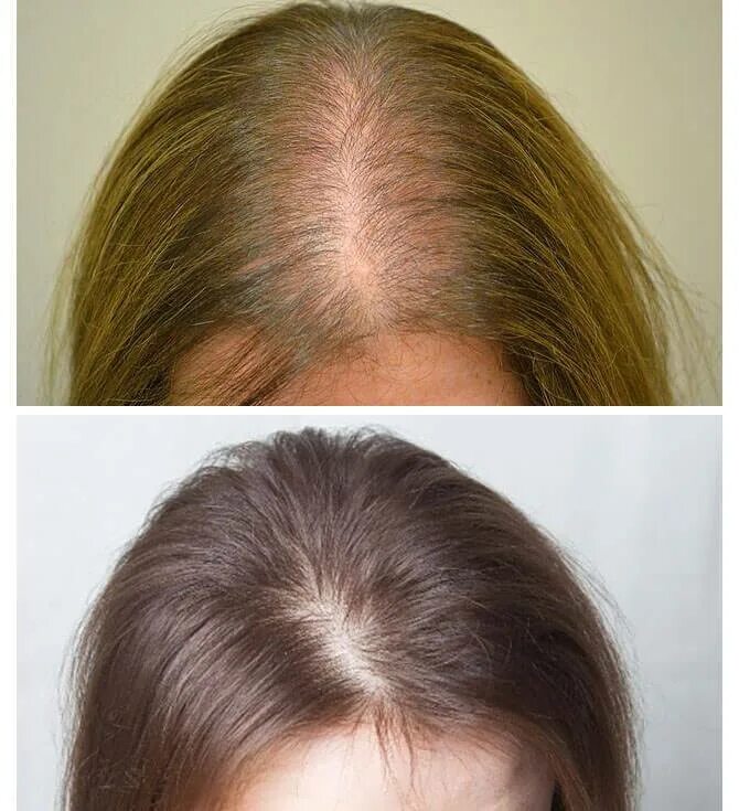 Ковид волосы выпадают что делать. Андрогенетическая алопеция. Сотное выпадение волос.