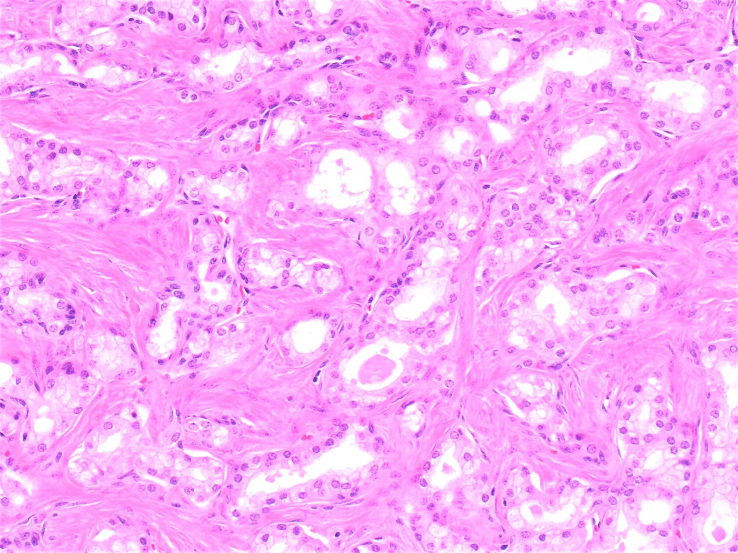 аденома простаты дгпж 2 степени. аденома органы. аденома органы. аденома органы. аденома предстательной железы (аденома простаты).