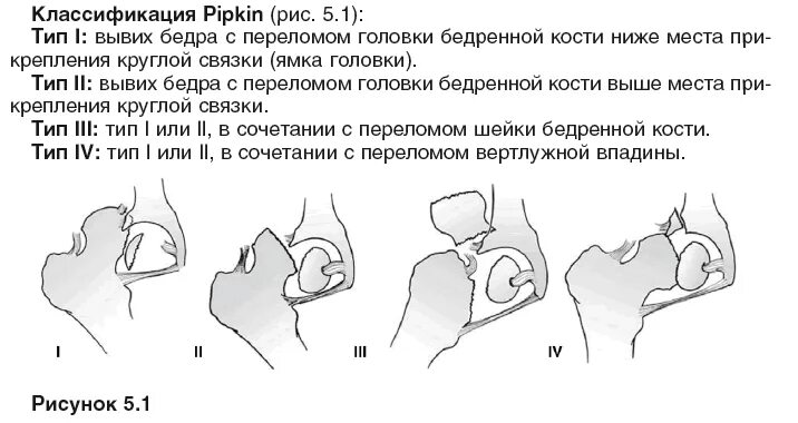 Перелом головки бедренной кости. Классификация переломов головки бедренной кости Pipkin. Перелом головки бедренной кости классификация. Переломы головки бедренной кости Пипкин. Перелом Пипкина классификация.