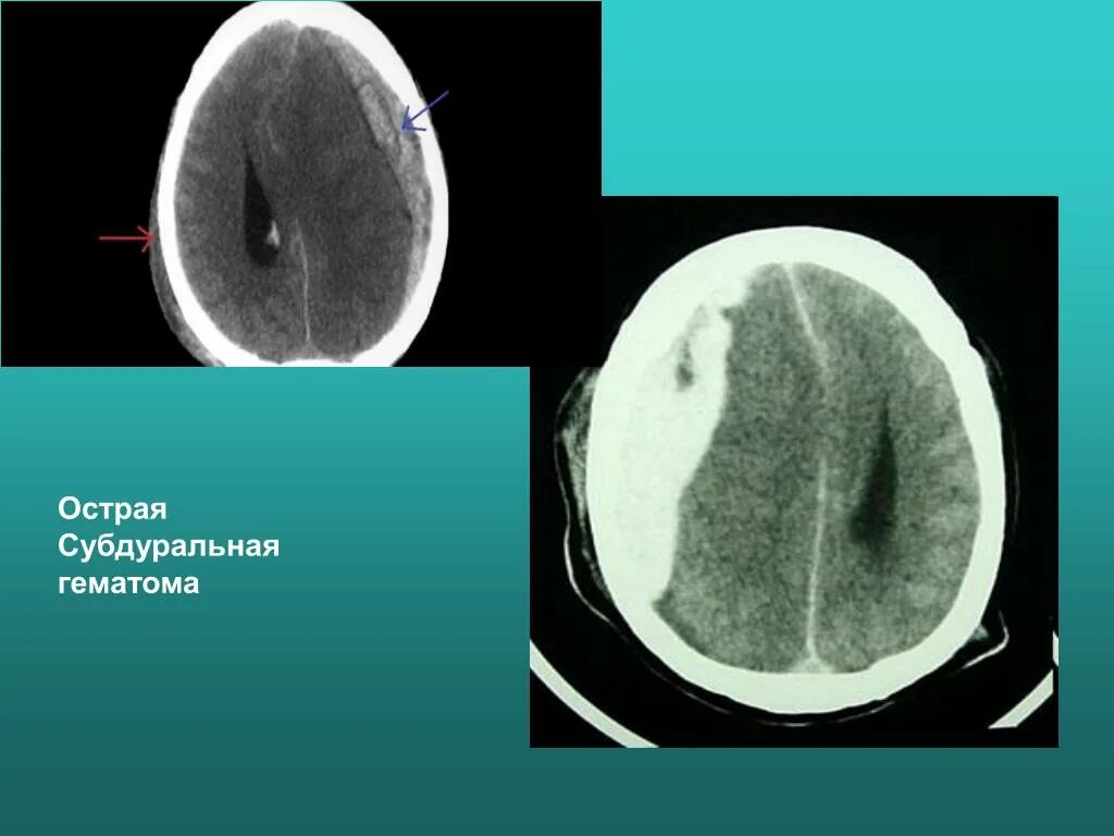 Пластинчатая субдуральная гематома кт. Субдуральное кровоизлияние кт. Острая и хроническая субдуральная гематома. Хроническая субдуральная гематома на кт. Гематома в стадии организации
