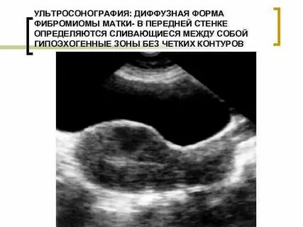 Диффузные изменения матки