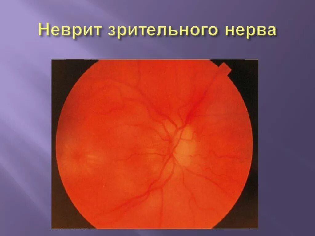 Интрабульбарный неврит зрительного нерва. Оптический неврит папиллит. H46 неврит зрительного нерва.. Ретробульбарный неврит глазное дно. Тип зрительного нерва