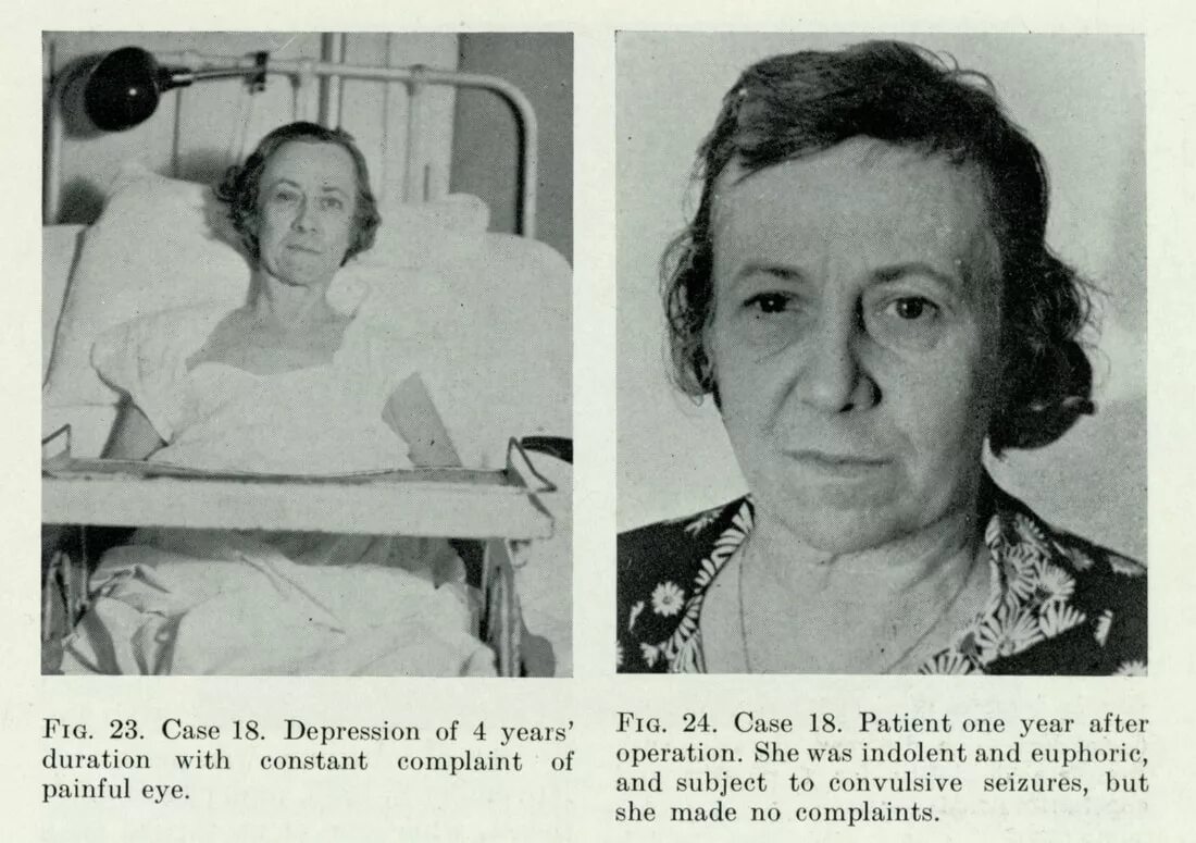 Пациенты были после операции. Розмари Кеннеди. Лоботомия Розмари сестра Джона после. Префронтальная Лоботомия операция.