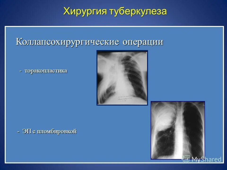 хирургические методы лечения туберкулеза легких. лобэктомия легкого показания. хирургическое лечение туберкулеза. хирургические формы легочного туберкулеза. после операция туберкулеза легких.