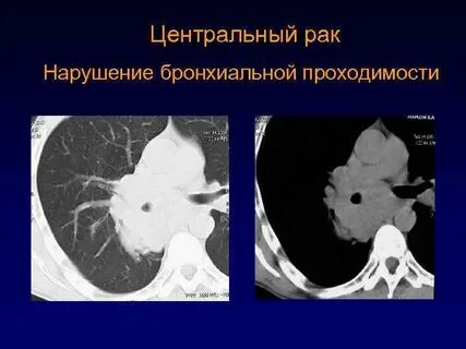 Нарушение бронхиальной проходимости