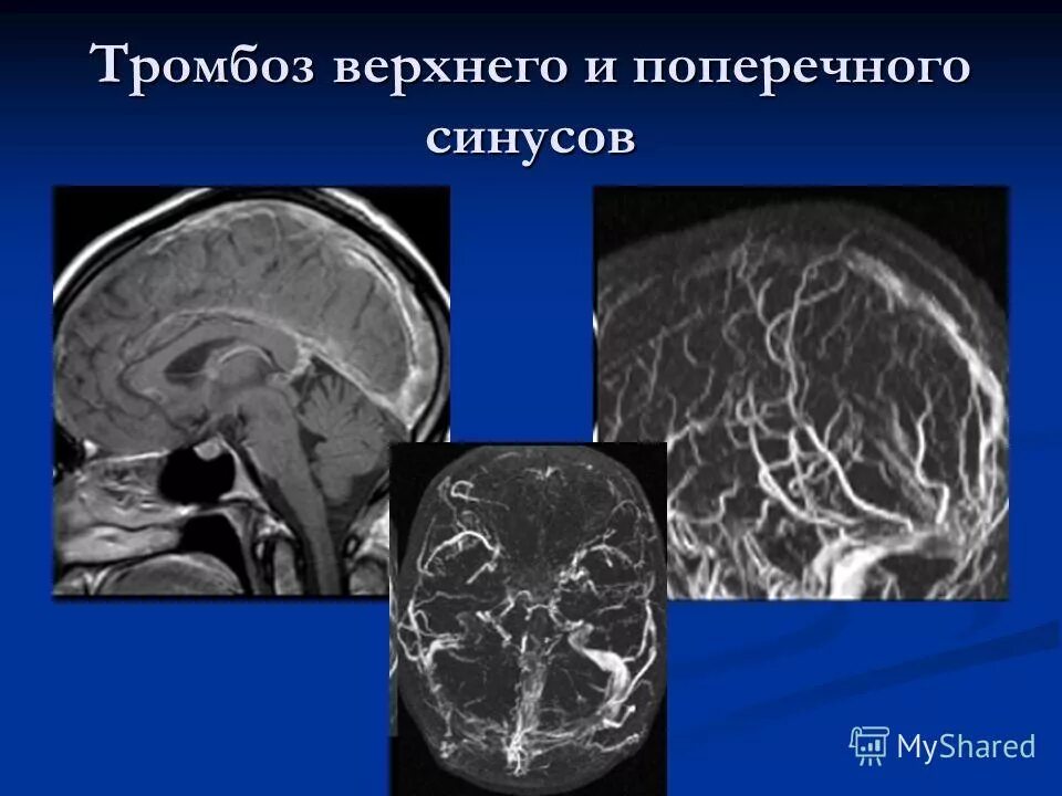 Гипоплазия правого поперечного синуса. Тромбоз поперечного синуса мрт. Тромбоз Вена Галена кт. Тромбоз синусов головного мозга кт. Тромбоз верхнего сагиттального синуса кт.