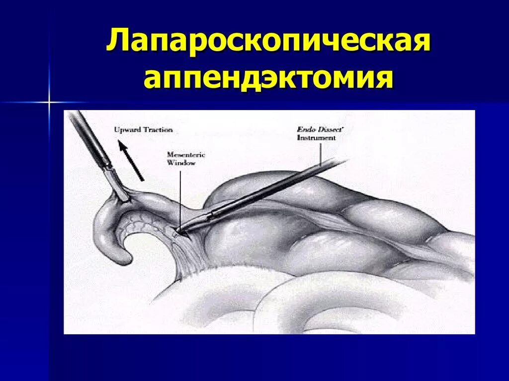 Что нельзя удаления аппендицита. Аппендэктомия Оперативная хирургия. Лапароскопический метод аппендэктомии. Лапароскопия аппендэктомия. Операция аппендикс лапароскопическая аппендэктомия.