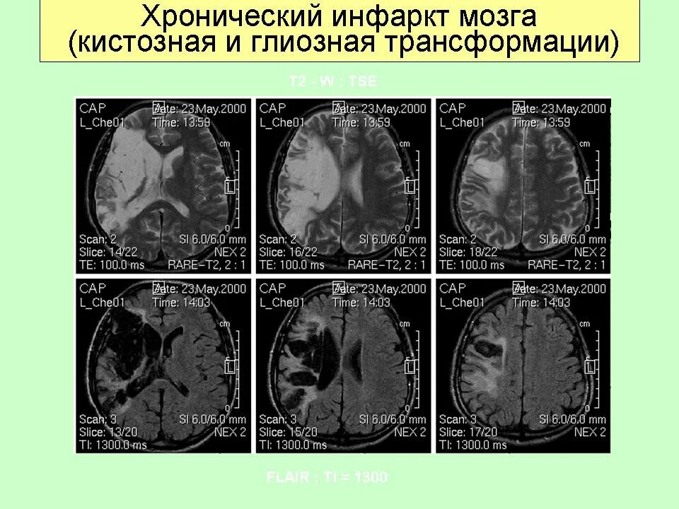 Глиозные изменения лобной доли