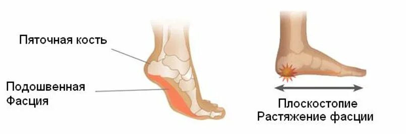 Пяточная шпора и плоскостопие. Болит пятка и свод стопы. Микроразрывы свода стопы. Прилипшая пятка характерна