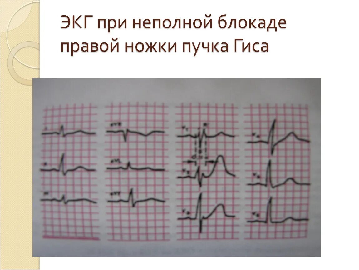 Что означает неполная блокада. ЭКГ при неполной блокаде правой ножки пучка Гиса. Неполная блокада правой ножки пучка Гиса. Неполная блокада правой ножки пучка Гиса на ЭКГ. Неполная блокада правой ножки Гиса.