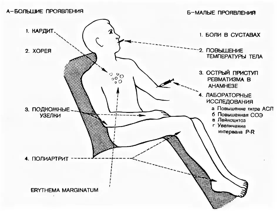 Лечение ревматизма суставов у взрослых. Симптоматика ревматизма. острая ревматическая лихорадка у детей симптомы.