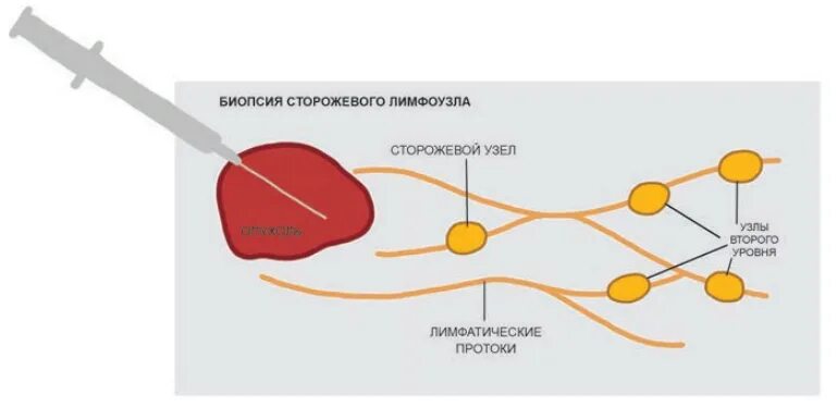 Сигнальный лимфоузел. Сторожевой лимфатический узел молочной железы. Лимфатические узлы молочной железы. Сторожевые лимфоузлы молочной железы расположение. Региональные лимфатические узлы молочной железы.