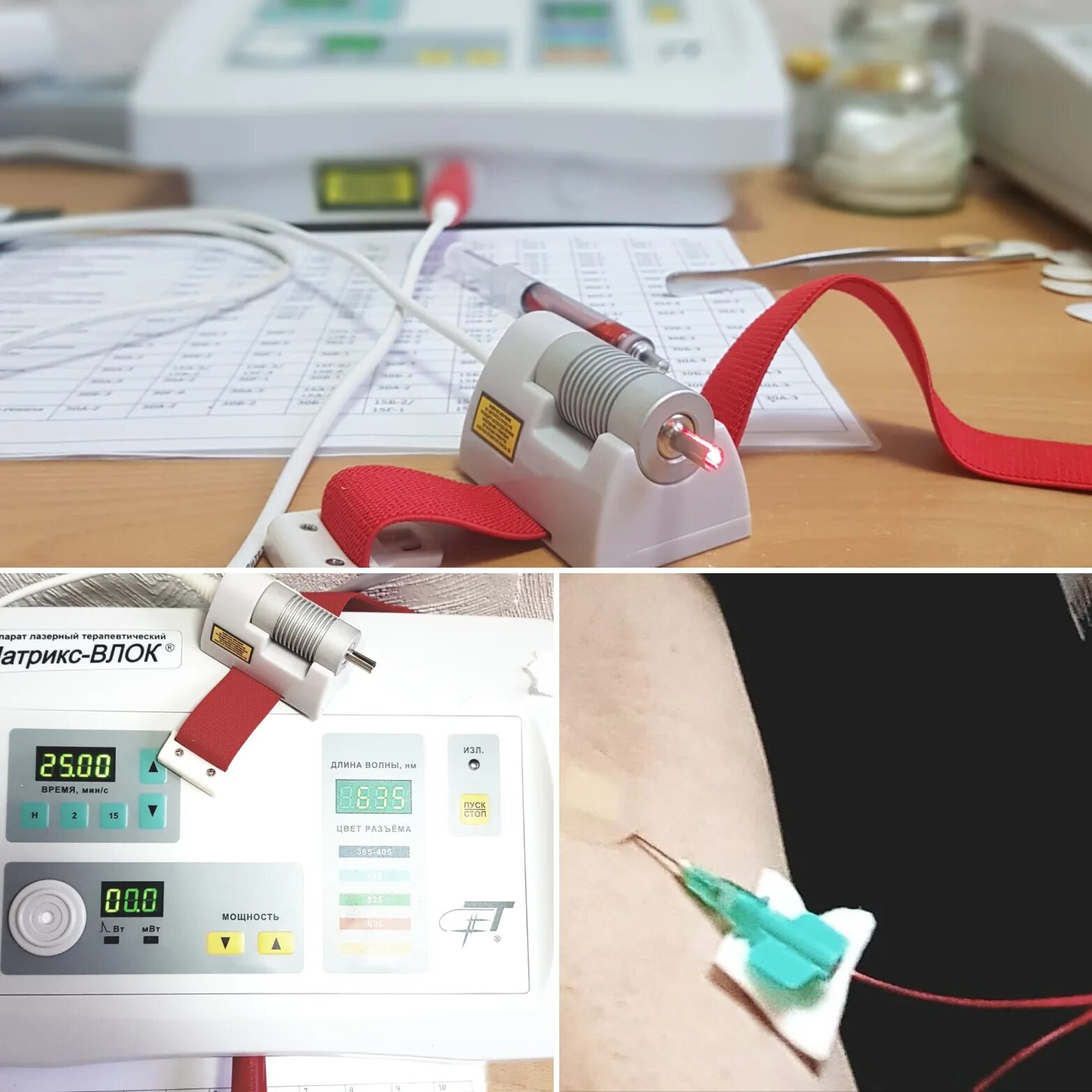Лазерное облучение крови ВЛОК. Матрикс ВЛОК аппарат. ВЛОК внутривенное лазерное облучение. Аппарат лазерный Матрикс-ВЛОК. Лазерный отзывы пациентов