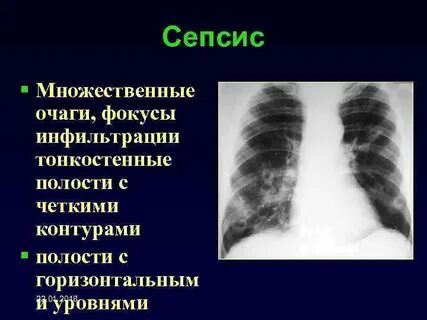 Четкие контуры очага в легком