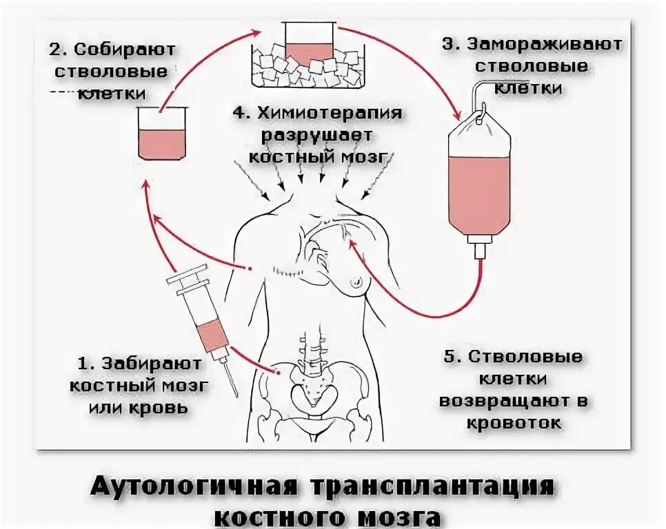 Трансплантация костного мозга. Трансплантация костного мозга показания этапы проведения. Трансплантация костного мозга этапы. Как происходит пересадка костного. Противопоказания к трансплантации костного мозга.