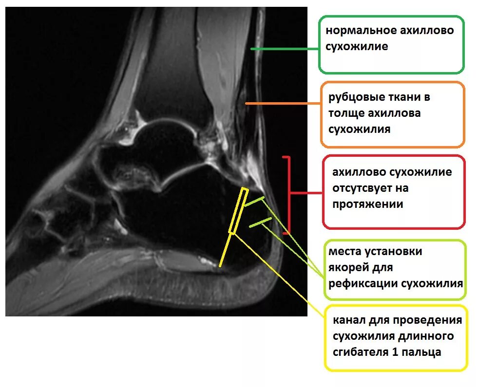 Паратендинит ахиллова сухожилия мрт. Тендиноз ахиллова сухожилия мрт. Бурсит ахиллова сухожилия рентген. Ахиллово сухожилие разрыв мрт.