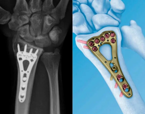 Остеосинтез операция пластины. Остеосинтез 3 пястной кости. Остеосинтез лучевой кости пластиной. Экстрамедуллярный остеосинтез голени. Перелом пластины остеосинтеза.