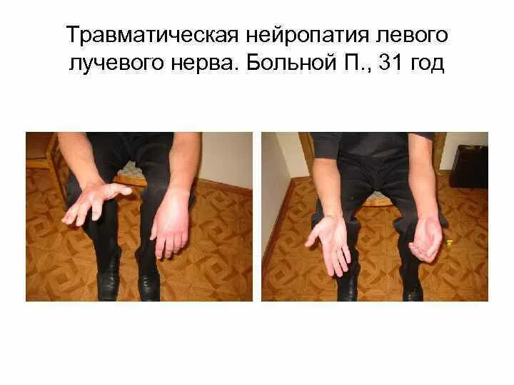 Нейропатия лучевого нерва. Посттравматическая невропатия лучевого нерва. Локтевой туннельный синдром. Лучевой нерв анатомия. Невропатия блокового нерва.