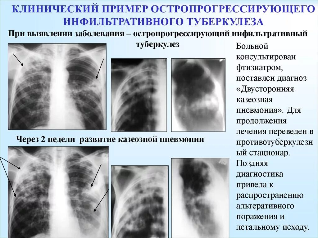 Внутренний туберкулез. Казеозная пневмония туберкулема. Инфильтративный туберкулез и казеозная пневмония. Казеозная пневмония туберкулез рентген. Инфильтративный туберкулёз лёгких рентген.