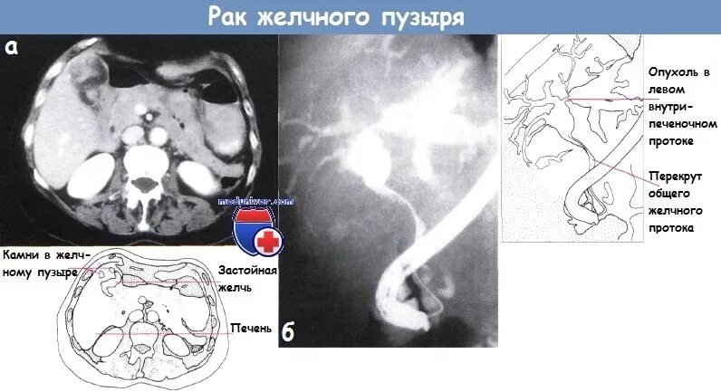 Отекает желчный пузырь. Опухоль общего желчного протока кт. Карцинома желчного пузыря кт. Кт картина опухоли желчного пузыря.