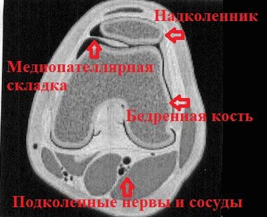 Медиопателлярная складка коленного сустава