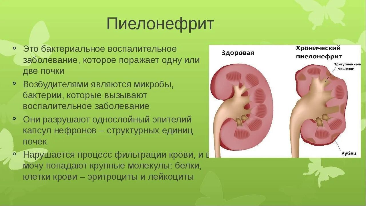 Мочевыделительная система заболевания пиелонефрит. Болезнь почек пиелонефрит. Пиелонефрит заболевание органов мочевыделительной системы. Болезни мочевыделительной системы у детей пиелонефрит.