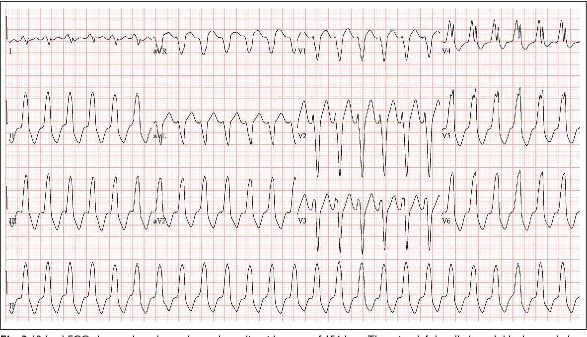 Ventricular tachycardia ECG. Изменчивая форма QRS. Изменчивая форма QRS заболевания. Размазанный комплекс QRS.