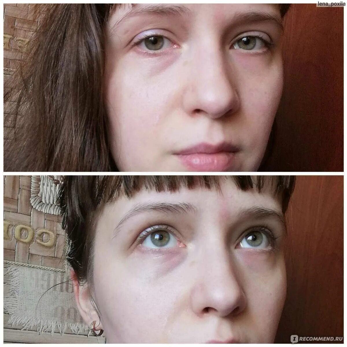 Глазами быстро и навсегда. Мешки и синяки под глазами. врожденные синяки под глазами.