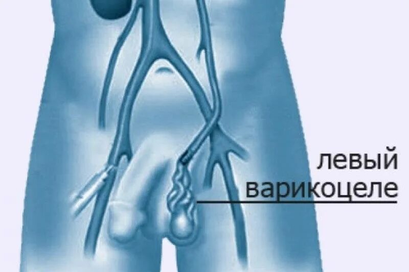 Расширение вены семенного канатика. Варикоцеле-расширение вен семенного канатика яичка. Варикоз вен семенного канатика. Левосторонний варикоз вены семенного канатика.