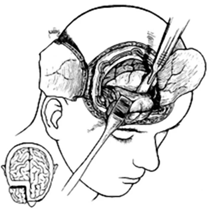 Транс орбитальная Лоботомия. Орбитокласт Лоботомия.