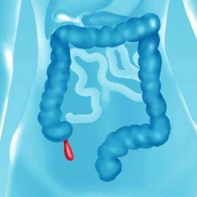 Как называется аппендикс. Аппендикс у человека рудимент. Поверхностный аппендицит.