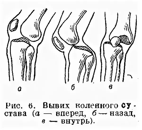 Растяжение связок коленного сустава мкб. Вывих коленного сустава схема. подвывих коленного сустава схема. задний вывих коленного сустава. передний вывих коленного сустава.