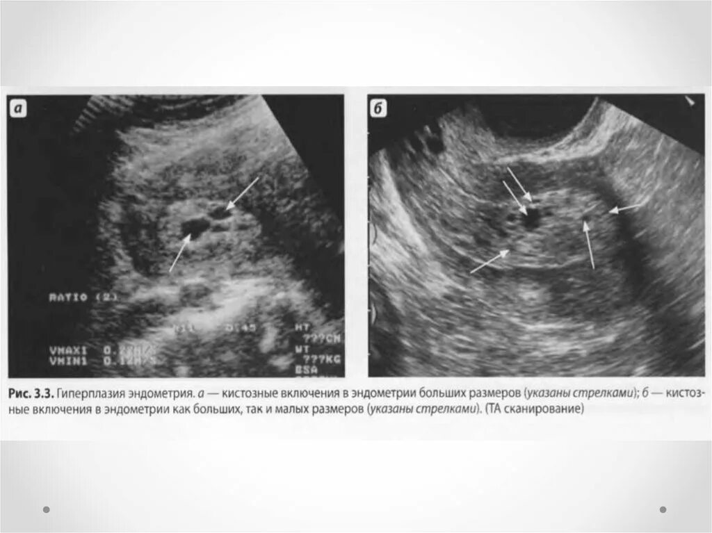 Эндометрия разрастается. Эхография гиперплазии эндометрия. Кистозные включения УЗИ эндометрий. Кистозная гиперплазия эндометрия на УЗИ.