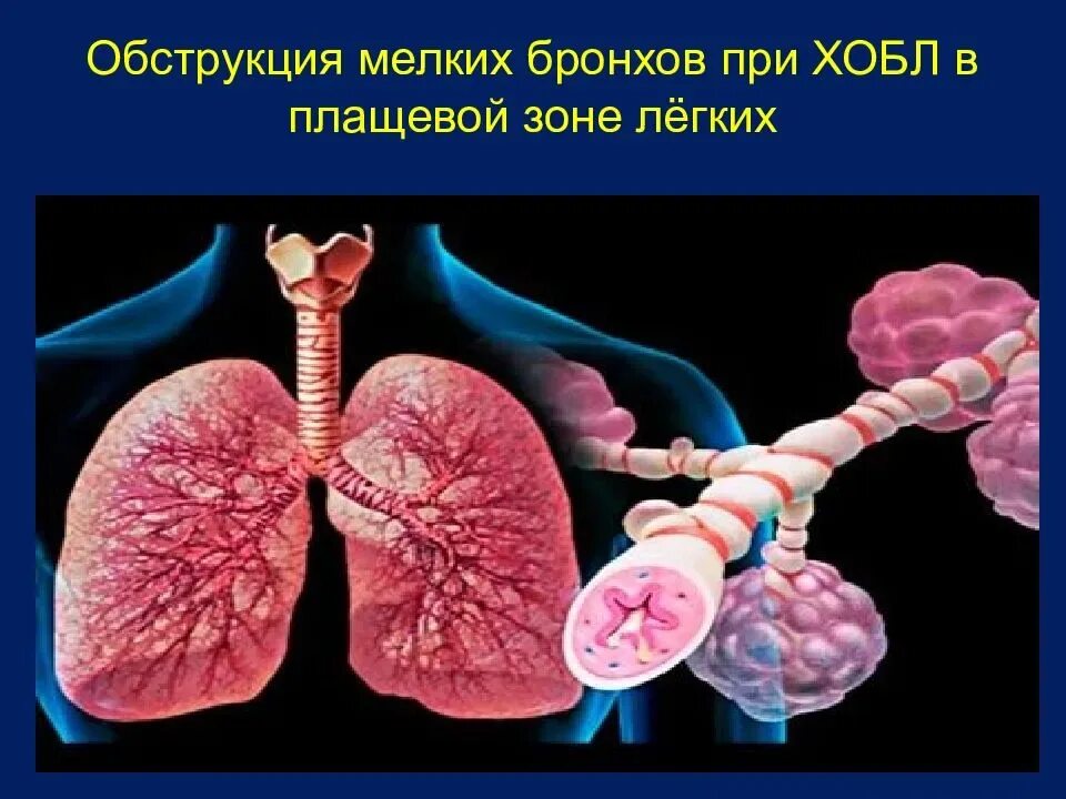 Обструктивный тип нарушения функции легких. Хроническая обструктивная болезнь легких. роническая обструктивная болезнь лёгких. лгхроническая обструктивная болезнь лёгких. обструктивная болезнь лёгких (хобл).
